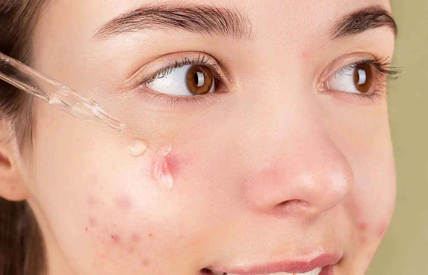 Woman applying facial serum - Best Serums For Acne