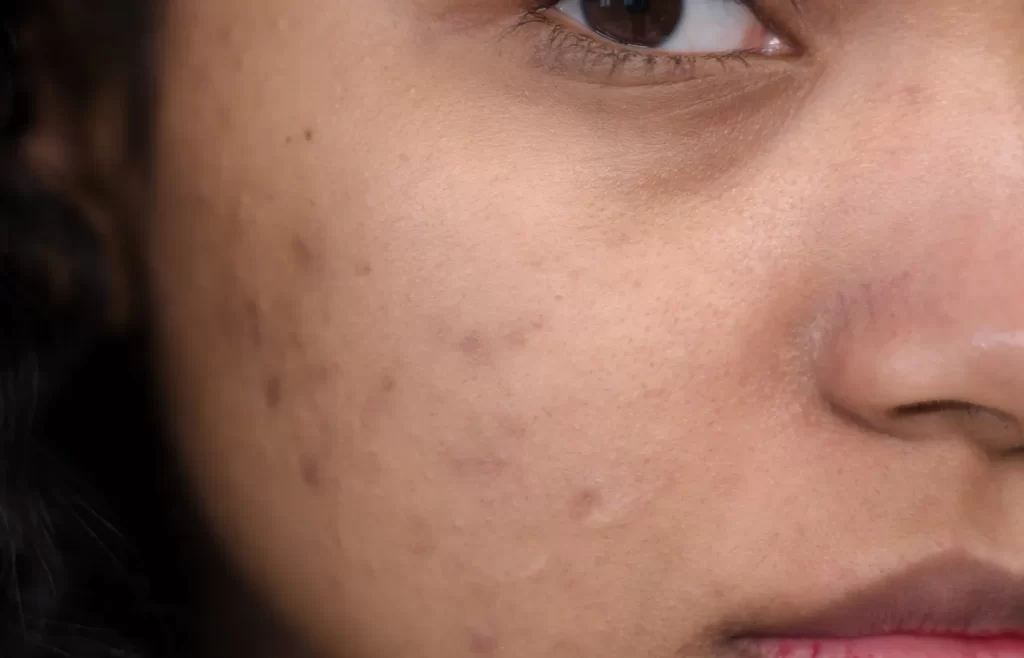 A close-up of woman's face - Best Skincare Products For Hyperpigmentation